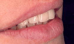 Upper Front Dental Bridges After