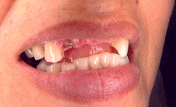 Upper Front Dental Bridges Before