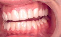 Dental Veneer Case Before