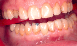 Implant After