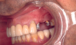 Implant Bridge Before 