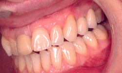 Implant Bridge  After