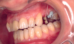 Implant Before