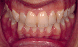 Dental Veneer Case Before